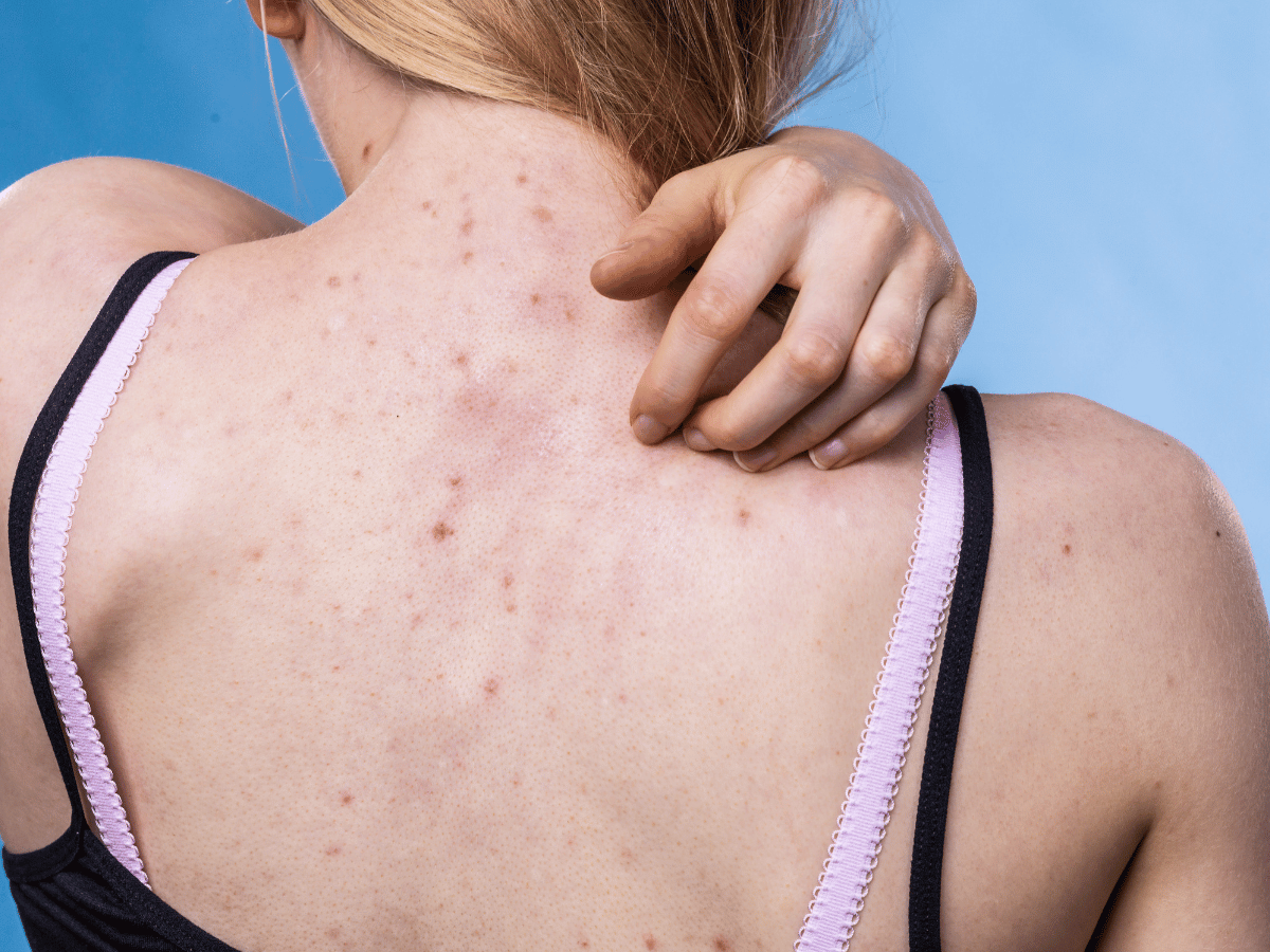 back with acne