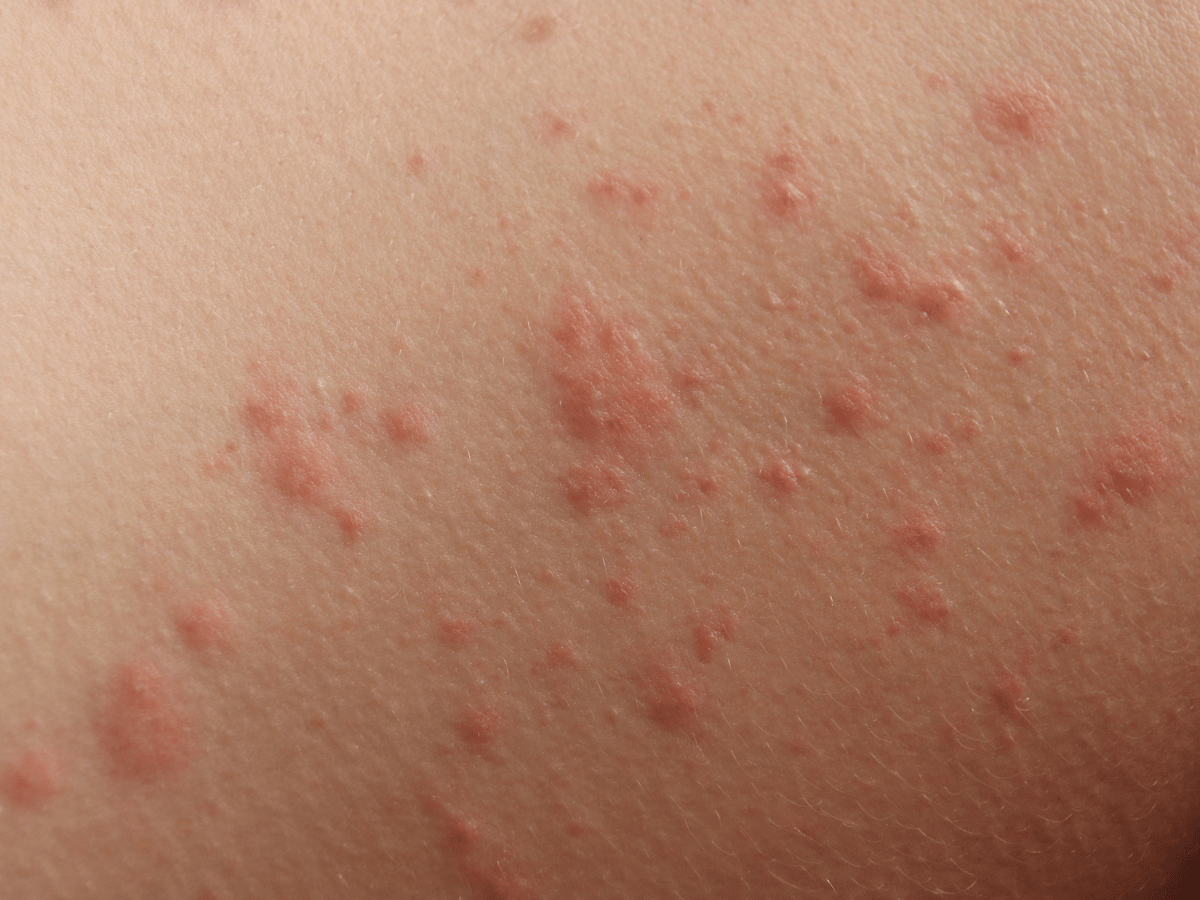 Contact Dermatitis Dermatology Institute