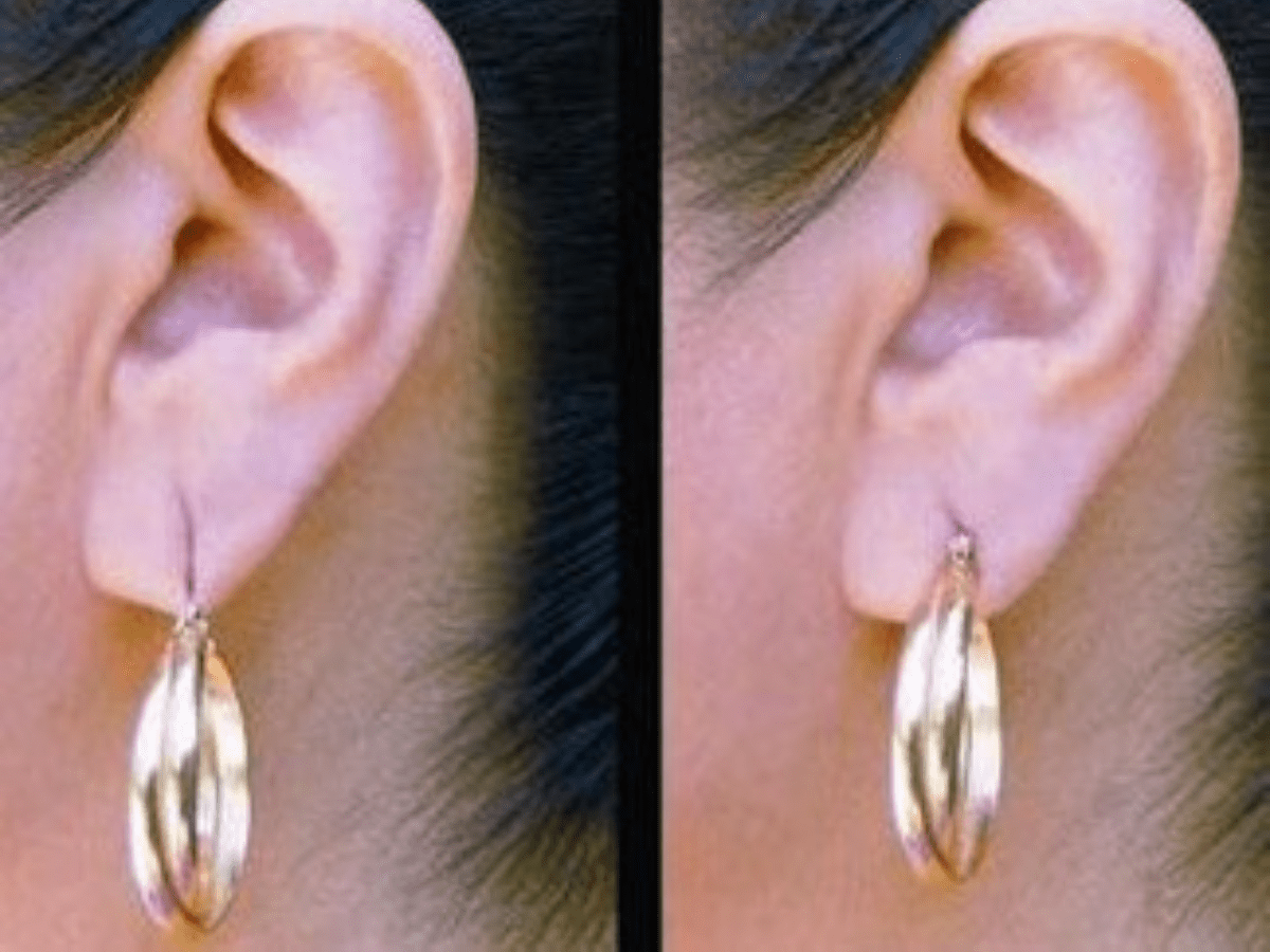 earlobe repair before and afte r