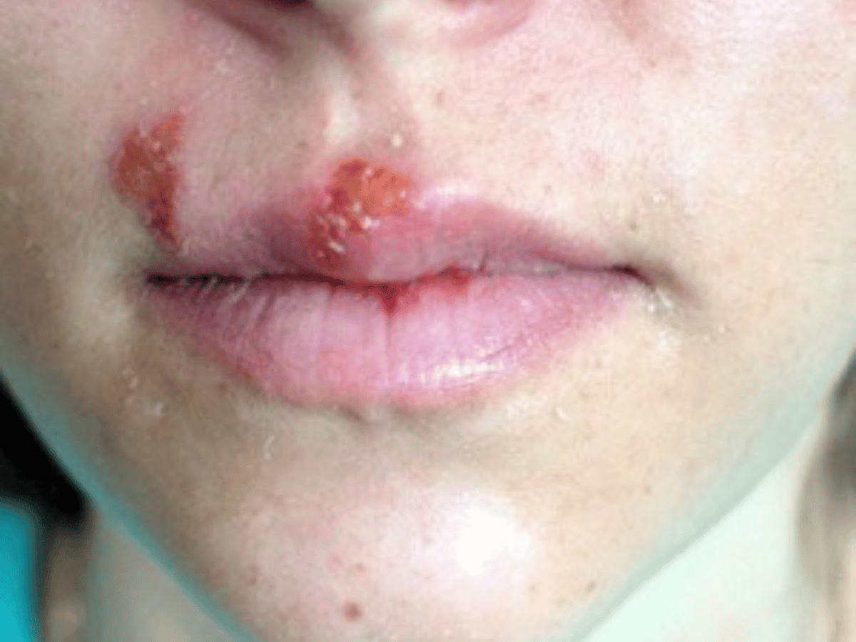 hsv on person's lip