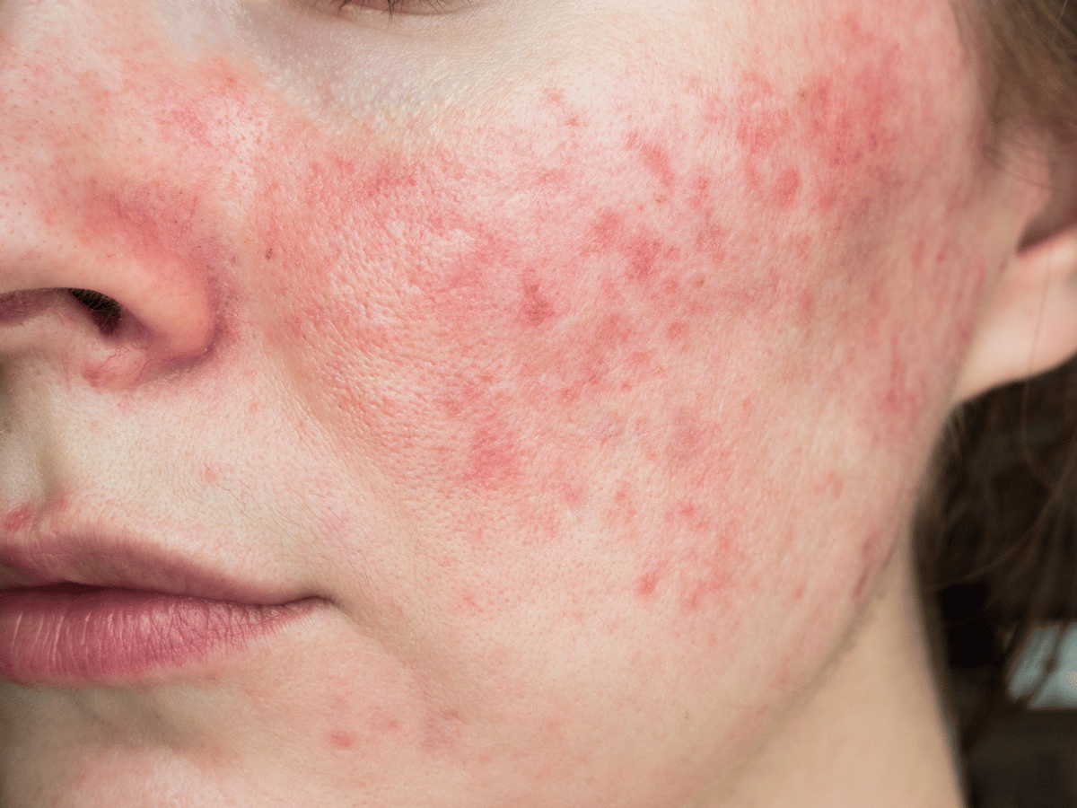 closeup of rosacea on cheek